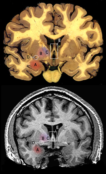 coronal2s.JPG (54752 bytes)