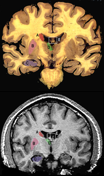 coronal3s.JPG (57317 bytes)