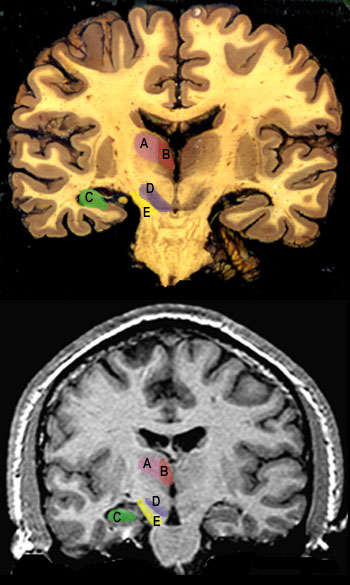 coronal4s.JPG (56692 bytes)