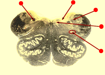 upper medulla