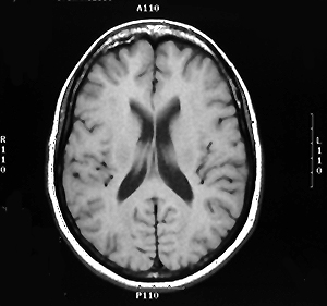 AD Horizontal MRI 