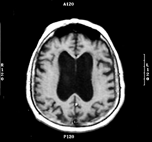 ALS Horizontal MRI 