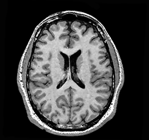 Normal Horizontal MRI 