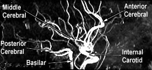 MRA Lateral Labelled