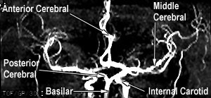 MRA AP Collapsed Labelled