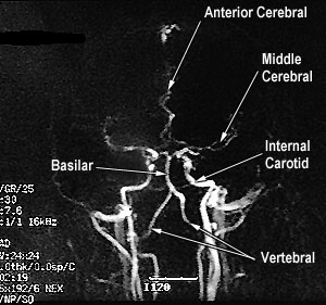 MRA AP Labelled