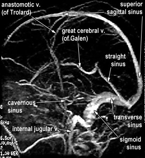 MRV lateral view