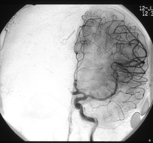 Normal Carotid AP View