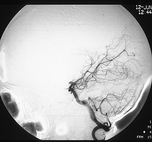 Normal Vertebral